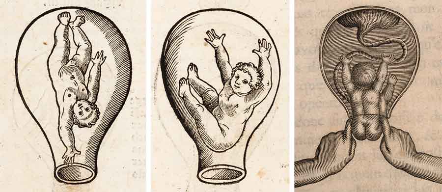 Left and center: Illustrations of fetuses in utero from Eucharius Rösslin’s Der swangern Frauwen und hebammen Rosegarten, 1513. Right: Illustration of a baby being teased out by two index fingers from Cosme Viardel’s Observations sur la pratique des accouchemens naturels, contre nature, & monstrueux, 1671.