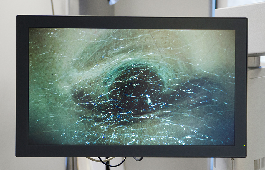 Magnified detail of one of The Blue Boy’s eyes, as it appears on the surgical microscope’s display screen.