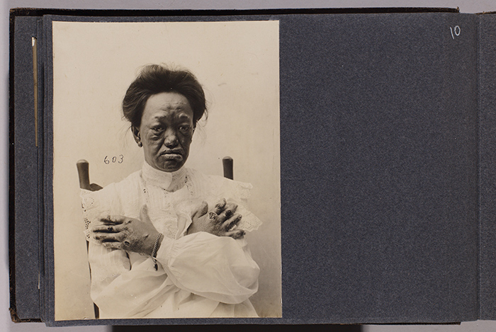 Miss Kanoelani Hart (case 603), age 22, from Waimea, Hawaii, July 3, 1906. Jack London Collection. The Huntington Library, Art Collections, and Botanical Gardens.