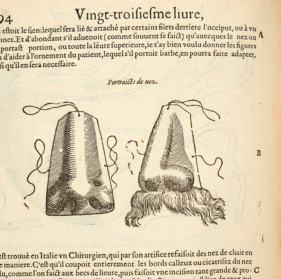 Illustration of prosthetic nose from 1614